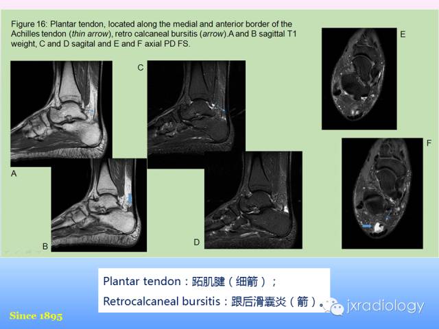 【PPT】足跟痛的MRI表现