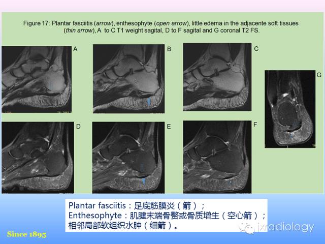 【PPT】足跟痛的MRI表现