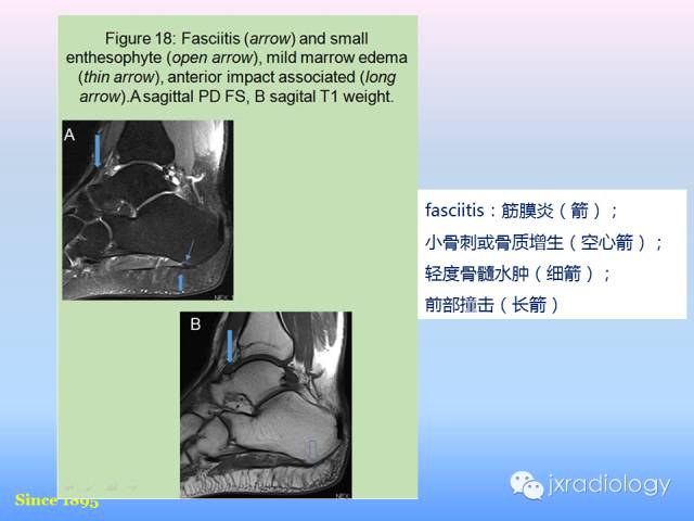 【PPT】足跟痛的MRI表现