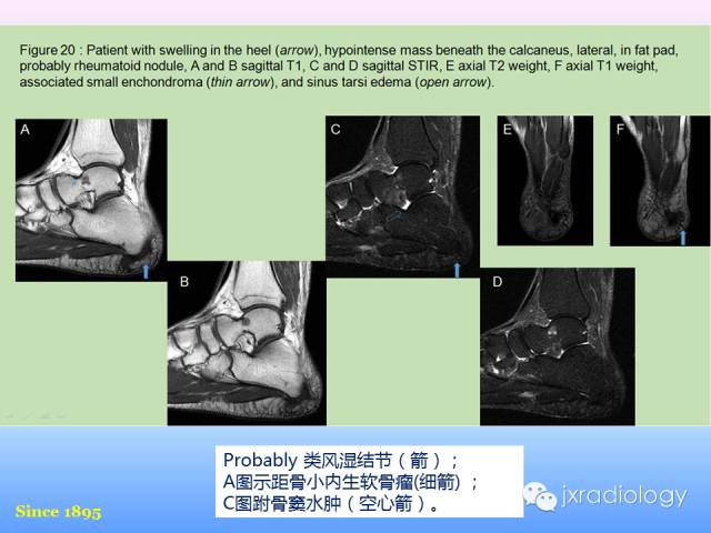 【PPT】足跟痛的MRI表现