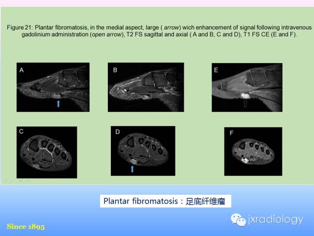 【PPT】足跟痛的MRI表现