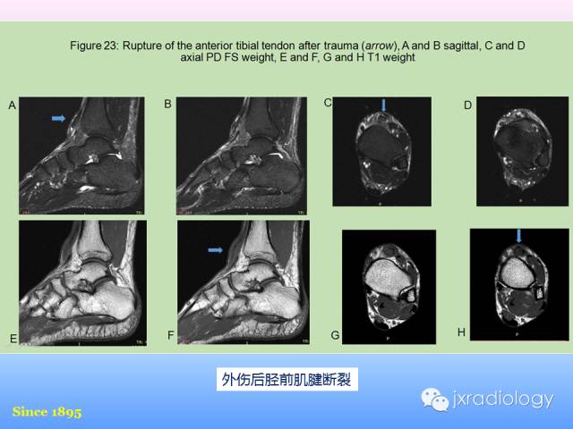 【PPT】足跟痛的MRI表现