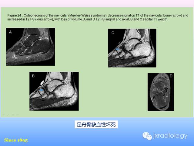 【PPT】足跟痛的MRI表现