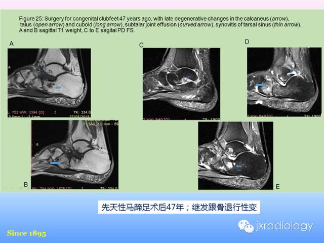 【PPT】足跟痛的MRI表现