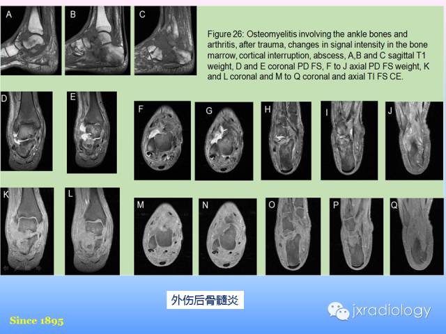 【PPT】足跟痛的MRI表现
