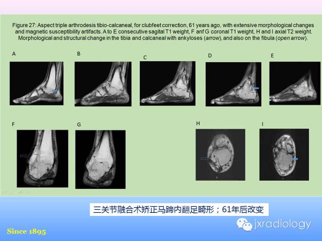 【PPT】足跟痛的MRI表现
