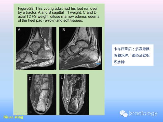 【PPT】足跟痛的MRI表现