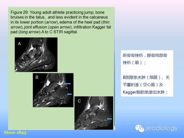 【PPT】足跟痛的MRI表现