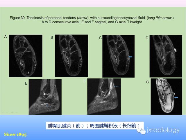 【PPT】足跟痛的MRI表现
