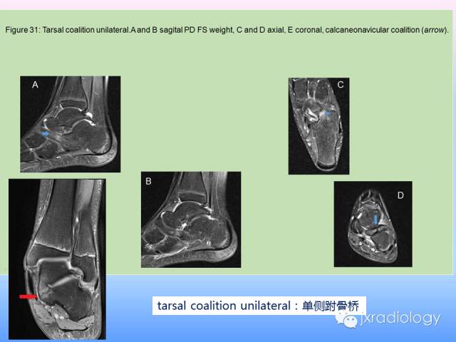 【PPT】足跟痛的MRI表现