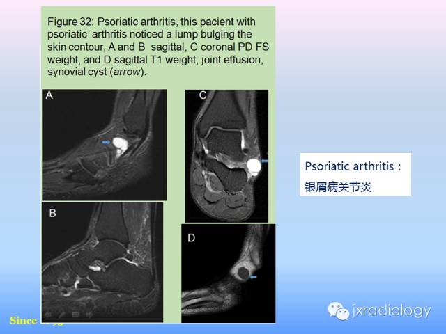 【PPT】足跟痛的MRI表现