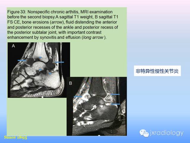 【PPT】足跟痛的MRI表现