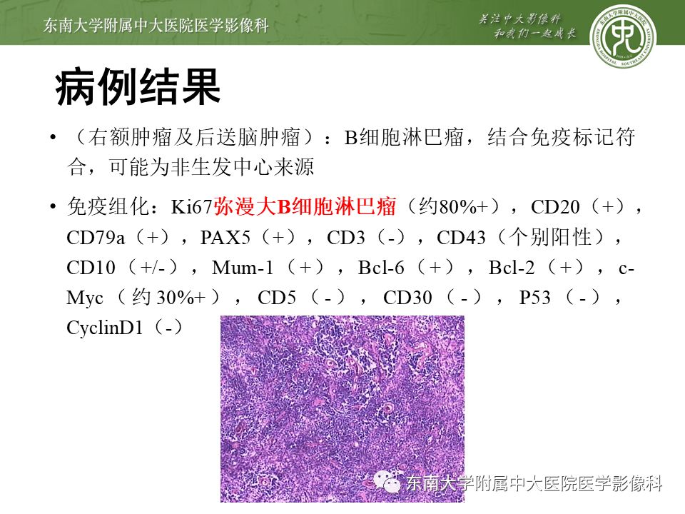 【病例】原发性中枢神经系统淋巴瘤1例CT及MR