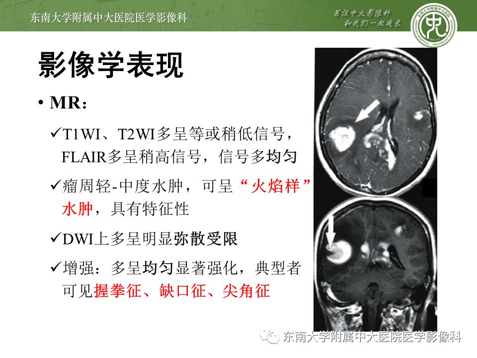 【病例】原发性中枢神经系统淋巴瘤1例CT及MR