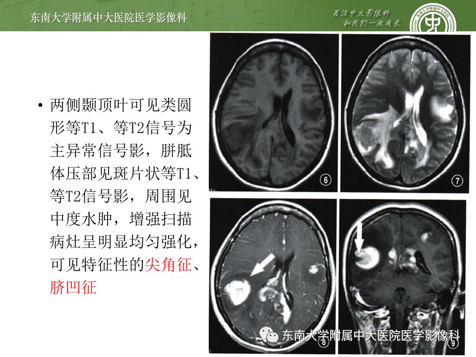 【病例】原发性中枢神经系统淋巴瘤1例CT及MR