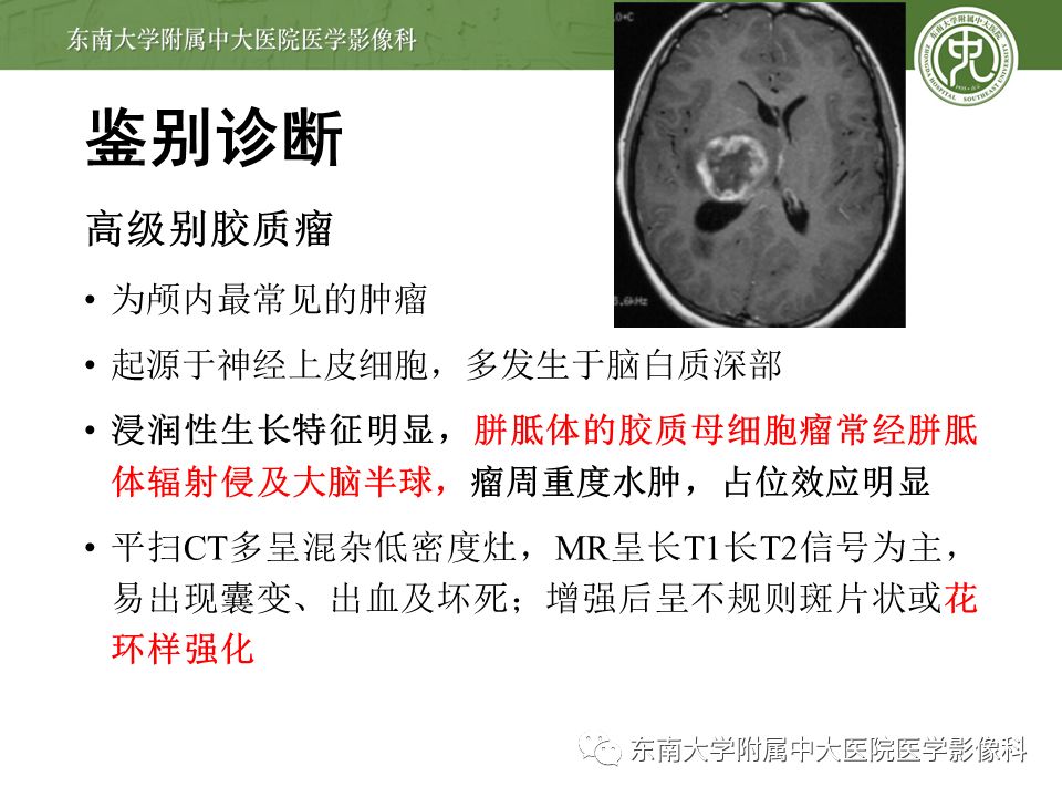 【病例】原发性中枢神经系统淋巴瘤1例CT及MR