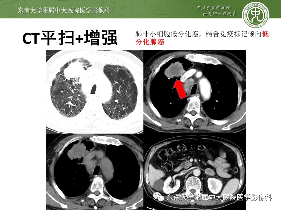 【病例】原发性中枢神经系统淋巴瘤1例CT及MR