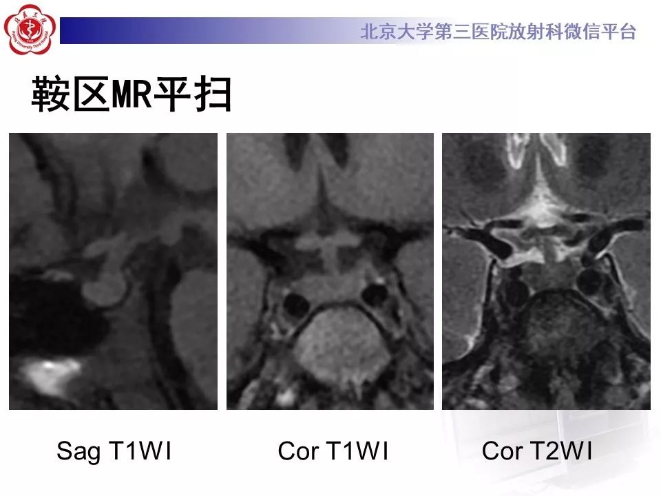 【病例】淋巴细胞性垂体炎2例MR