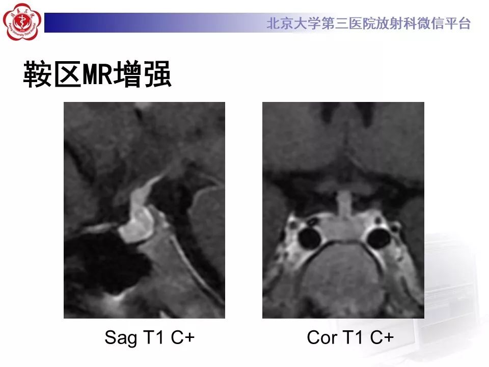 【病例】淋巴细胞性垂体炎2例MR
