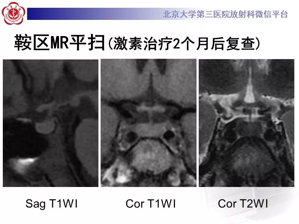 【病例】淋巴细胞性垂体炎2例MR