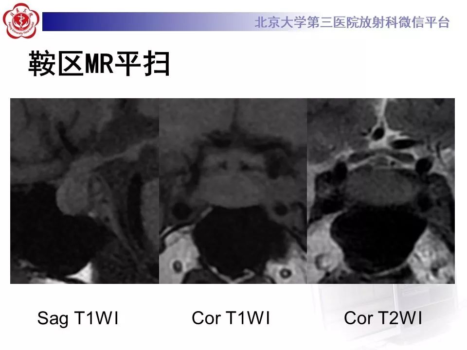 【病例】淋巴细胞性垂体炎2例MR