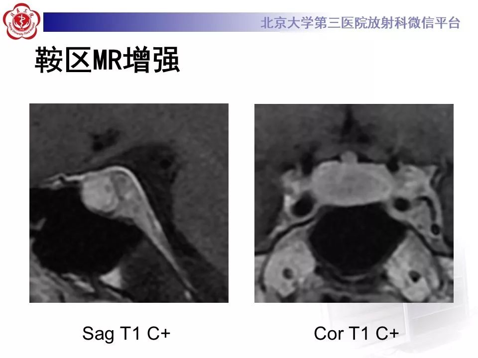 【病例】淋巴细胞性垂体炎2例MR