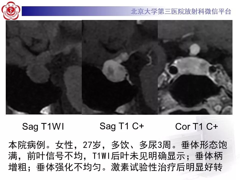 【病例】淋巴细胞性垂体炎2例MR