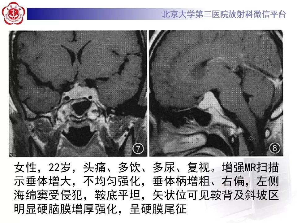 【病例】淋巴细胞性垂体炎2例MR