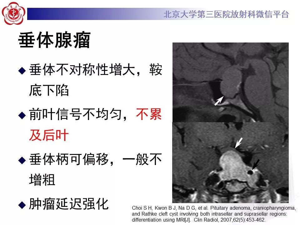 【病例】淋巴细胞性垂体炎2例MR