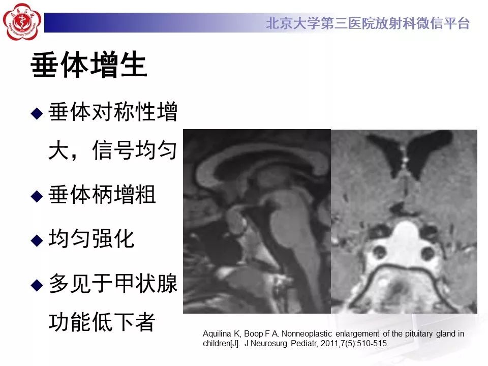 【病例】淋巴细胞性垂体炎2例MR