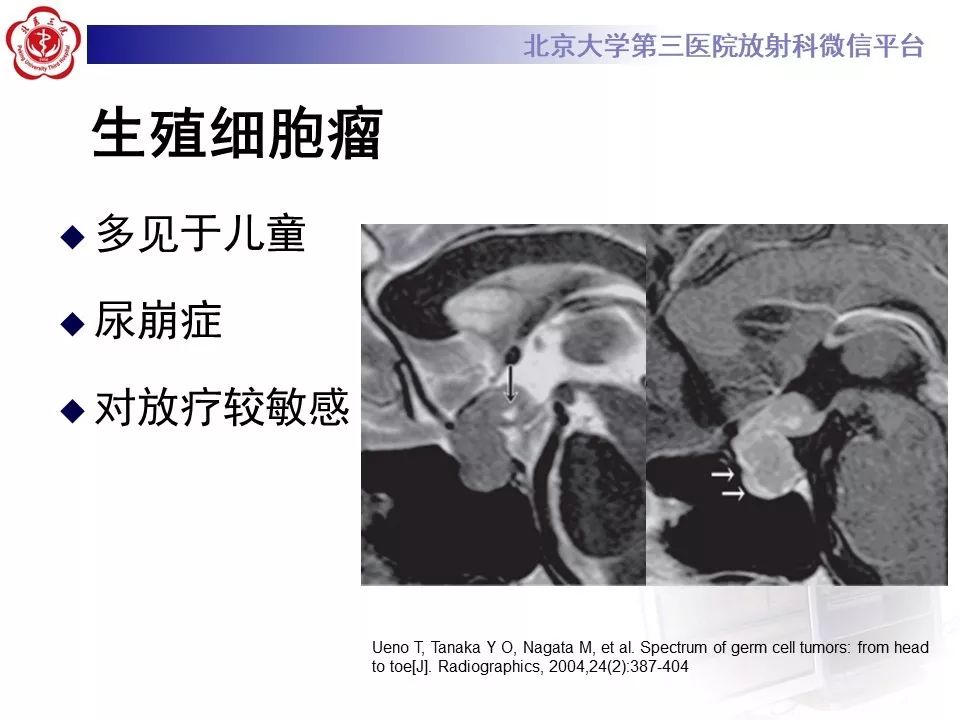 【病例】淋巴细胞性垂体炎2例MR