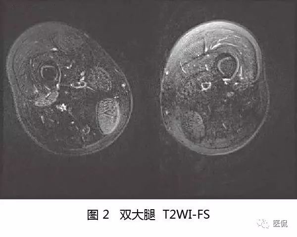 【病例】Berker型肌营养不良1例MR 【病例】Berker型肌营养不良1例MR