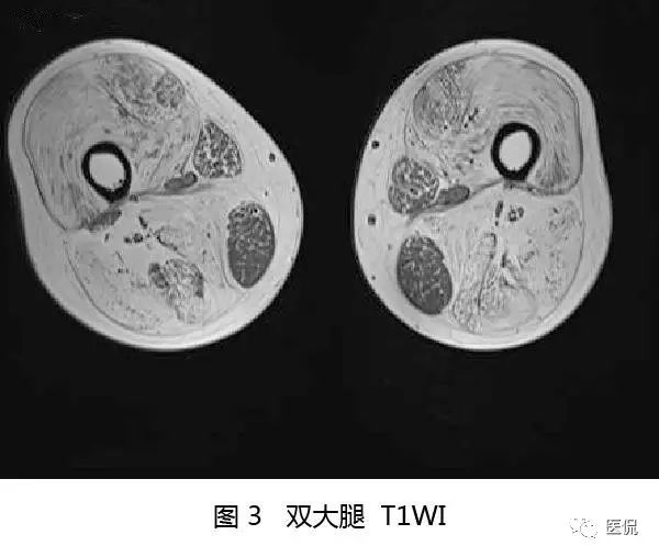 【病例】Berker型肌营养不良1例MR 【病例】Berker型肌营养不良1例MR