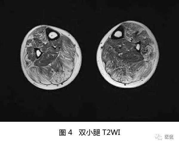 【病例】Berker型肌营养不良1例MR 【病例】Berker型肌营养不良1例MR