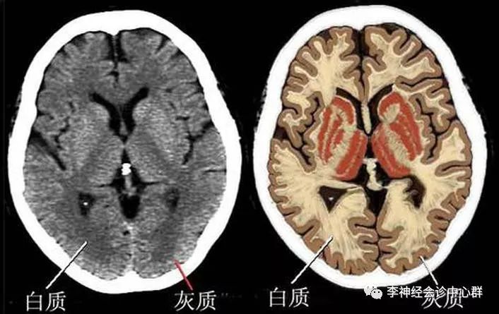 脑白质病变 Fazekas 分级 脑白质病变 Fazekas 分级