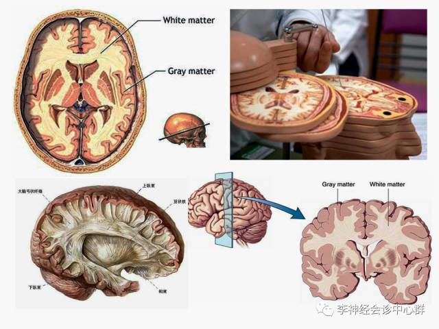 脑白质病变 Fazekas 分级 脑白质病变 Fazekas 分级