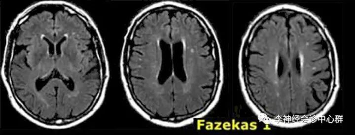 脑白质病变 Fazekas 分级 脑白质病变 Fazekas 分级
