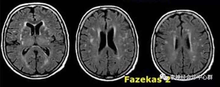 脑白质病变 Fazekas 分级 脑白质病变 Fazekas 分级