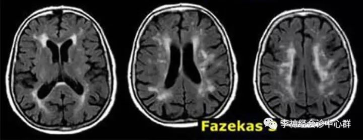 脑白质病变 Fazekas 分级 脑白质病变 Fazekas 分级