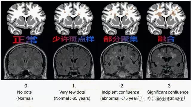 脑白质病变 Fazekas 分级 脑白质病变 Fazekas 分级