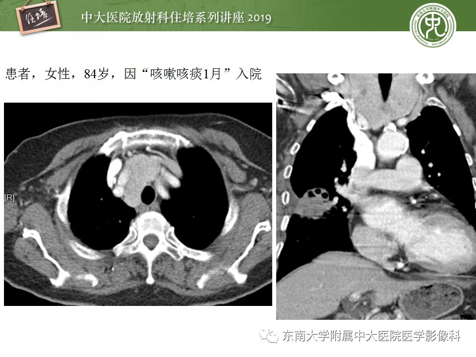 【PPT】纵隔分区及常见纵隔占位的影像诊断