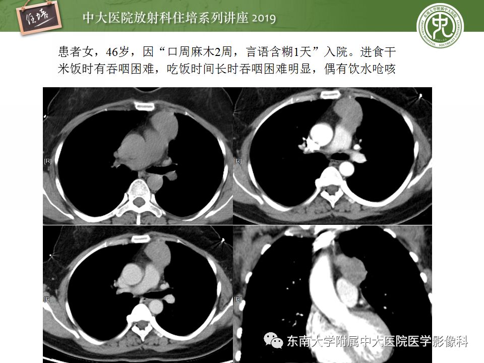 【PPT】纵隔分区及常见纵隔占位的影像诊断