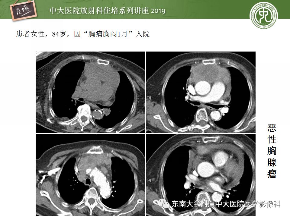 【PPT】纵隔分区及常见纵隔占位的影像诊断