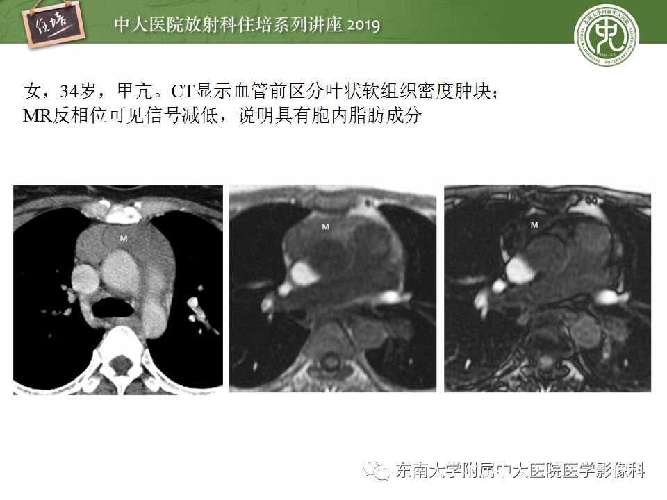 【PPT】纵隔分区及常见纵隔占位的影像诊断