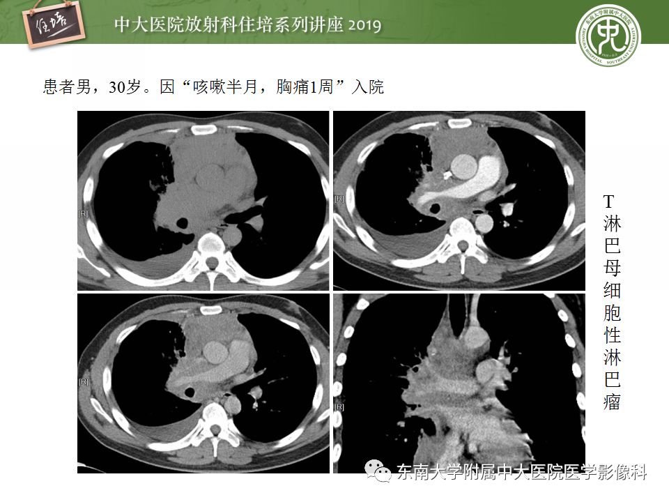 【PPT】纵隔分区及常见纵隔占位的影像诊断