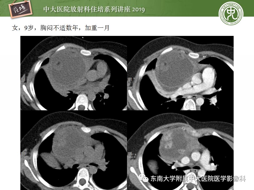 【PPT】纵隔分区及常见纵隔占位的影像诊断