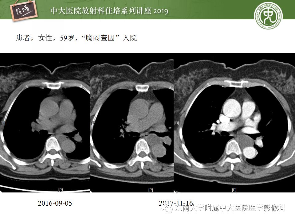 【PPT】纵隔分区及常见纵隔占位的影像诊断