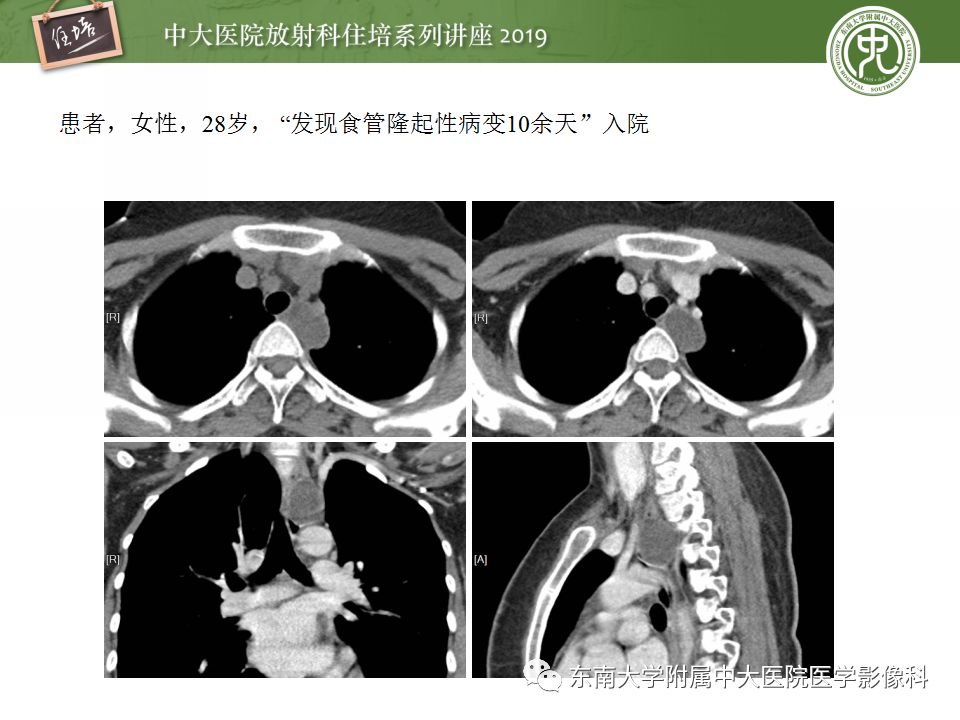 【PPT】纵隔分区及常见纵隔占位的影像诊断