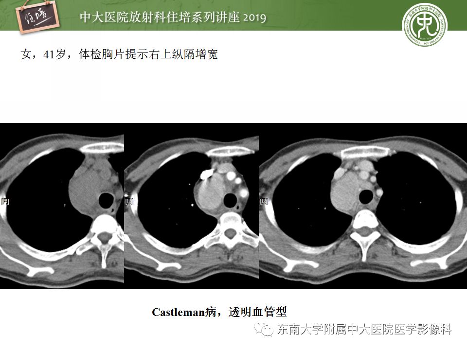 【PPT】纵隔分区及常见纵隔占位的影像诊断