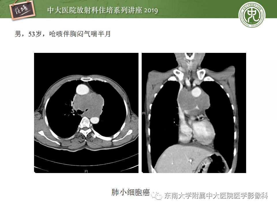 【PPT】纵隔分区及常见纵隔占位的影像诊断
